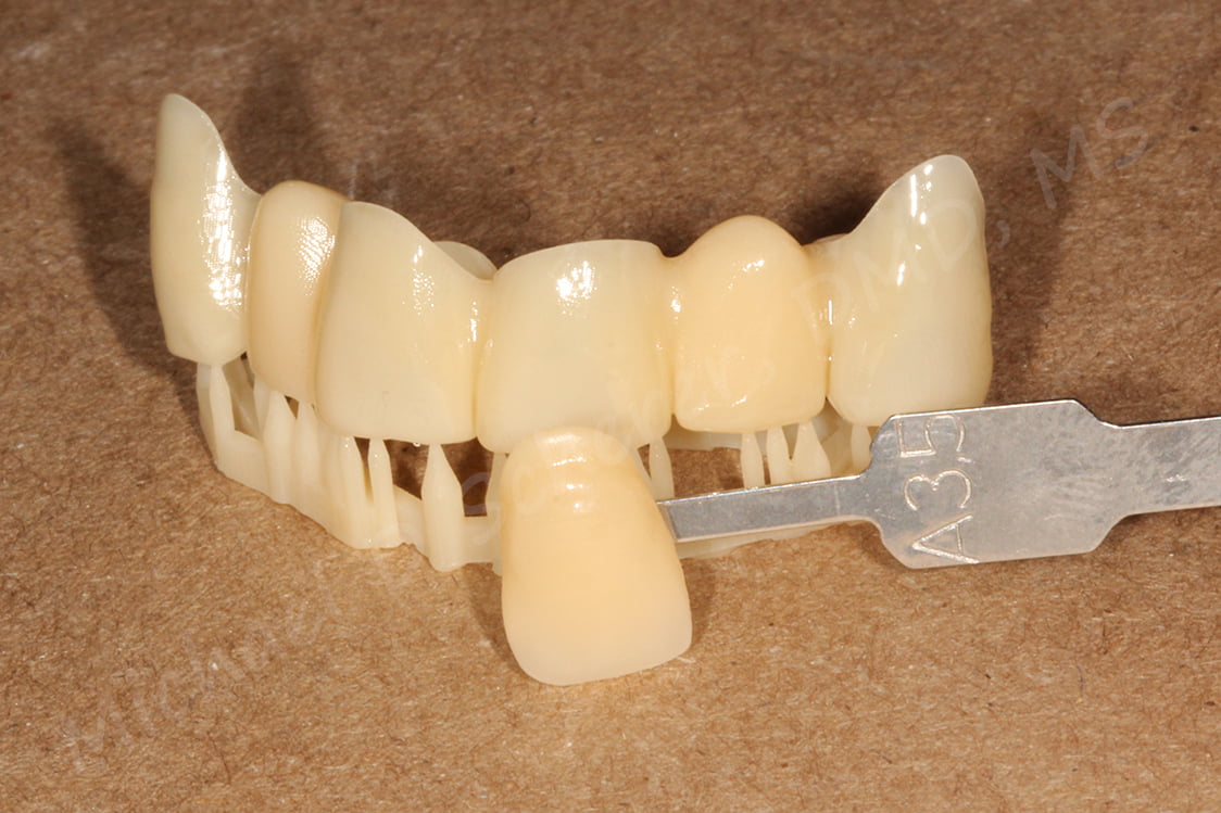 3D PRINTED TEMPORARY